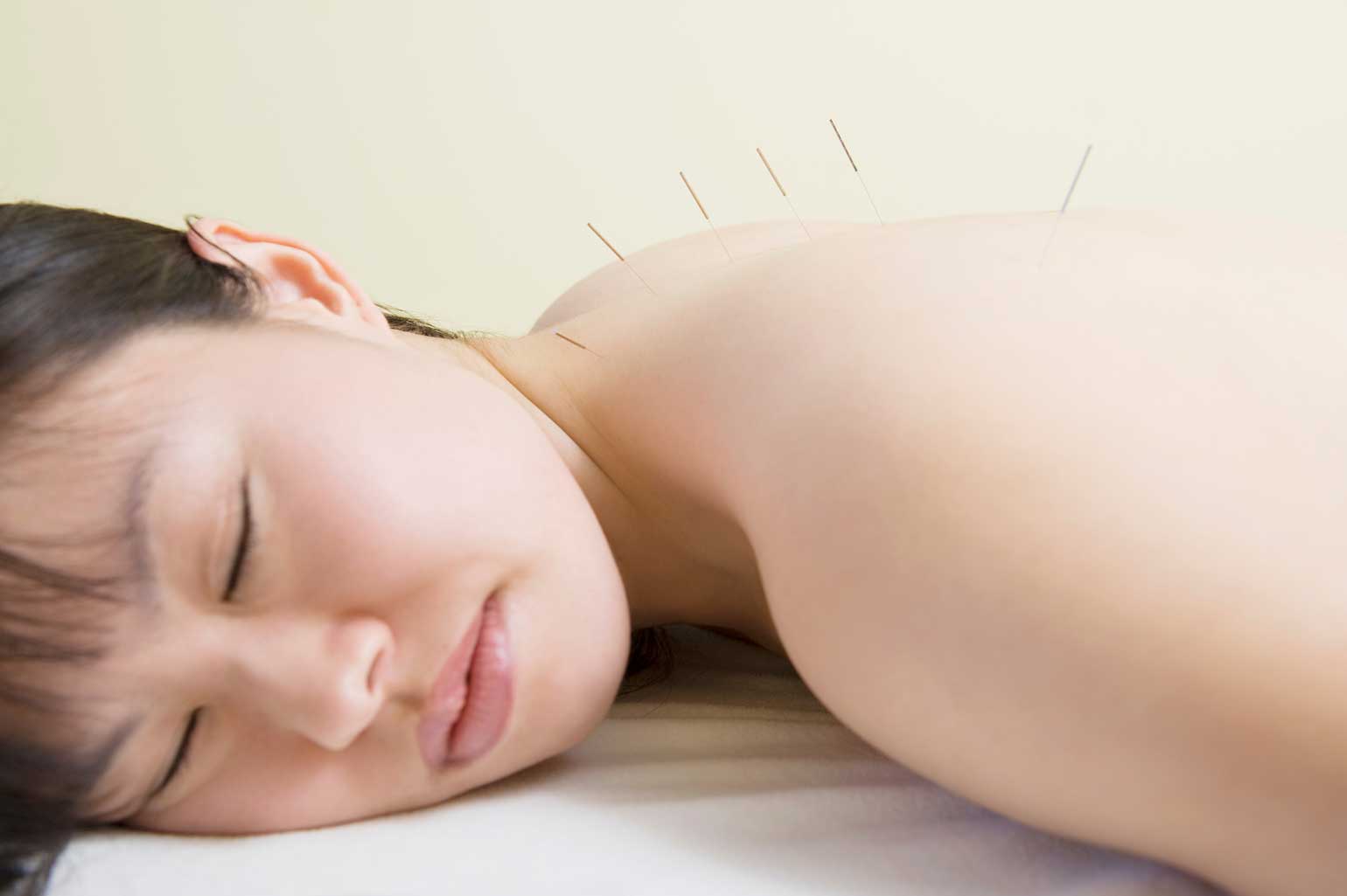 person receiving Acupuncture on back