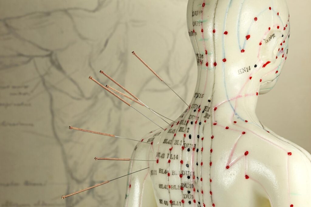 female acupuncture model with needles in the shoulder